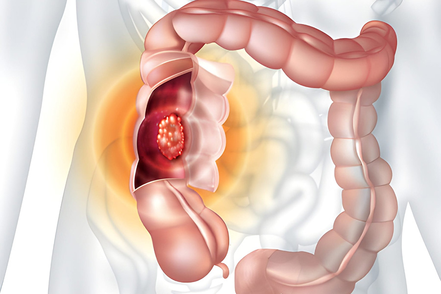 Types of Colorectal Cancer
